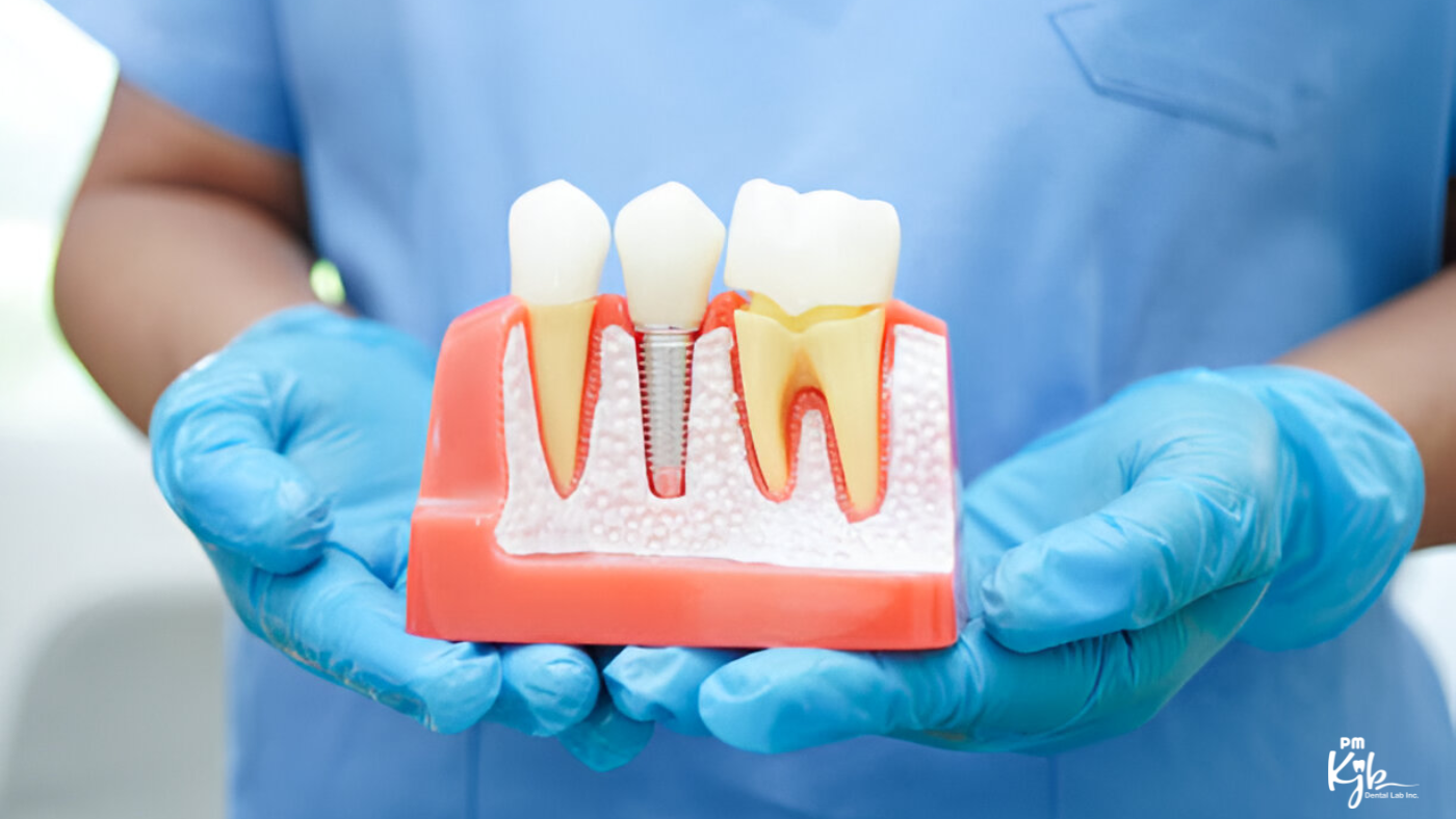 Dental Implants