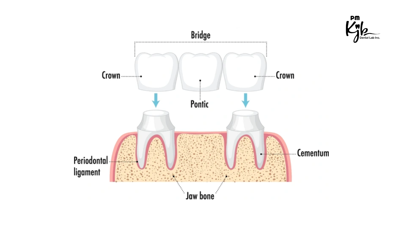 Crown and Bridge Treatment